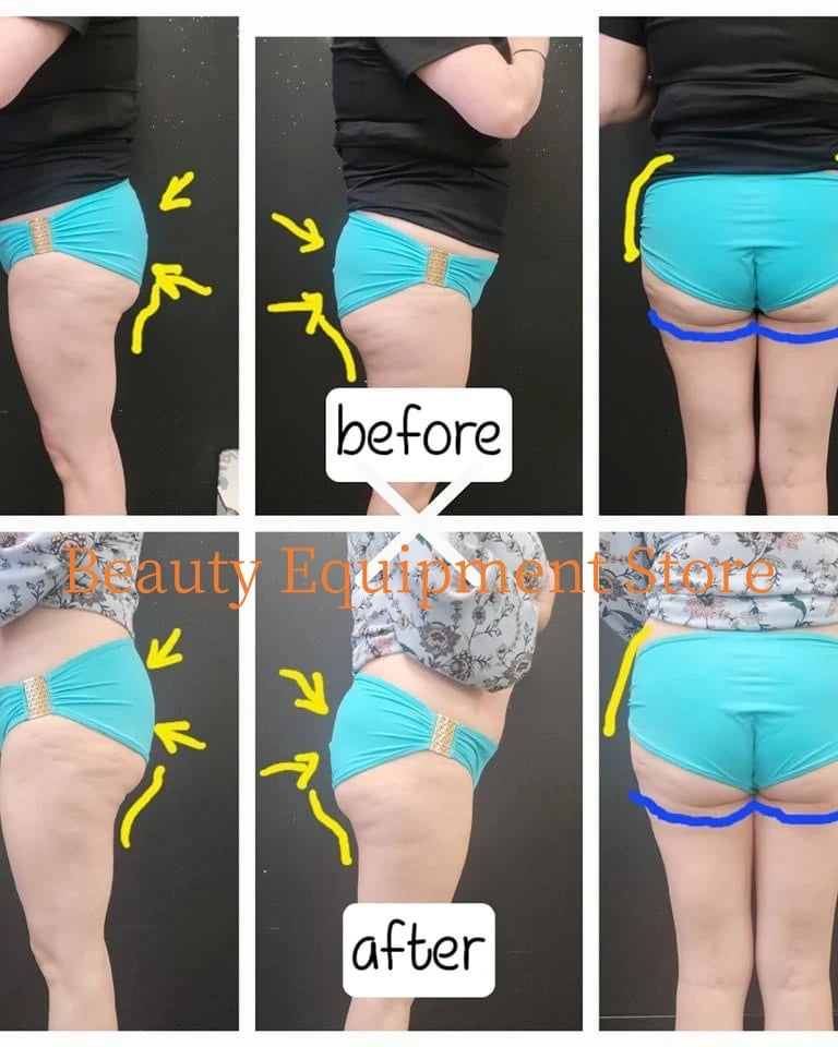 EMS Body Sculpt Machine Fat Burner With 4 Handles Pro